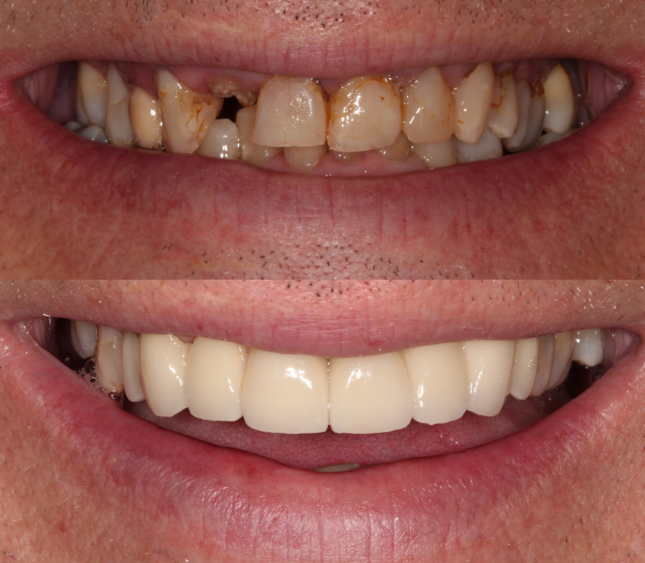 Missing Upper Lateral Incisor & Discolored Teeth - Duxbury MA