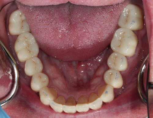 Image Lower Teeth Restored With Dental Reconstruction Surgery - Duxbury MA