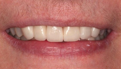 Anterior Teeth Restored To Achieved  A Healthy Natural Looking Smile - Duxbury MA