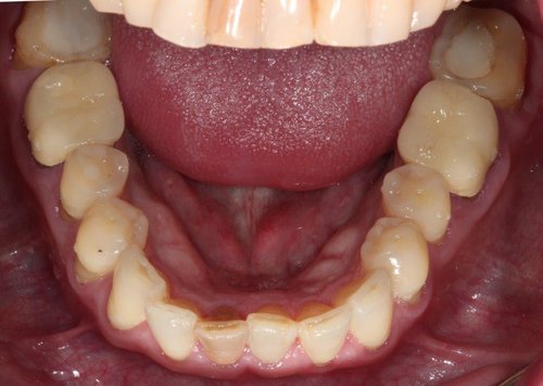 Image of lower teeth before full mouth reconstruction dentistry was proformed by Dr. Pellegrini