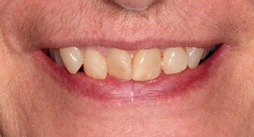 Worn & discolored anterior teeth - Duxbury MA